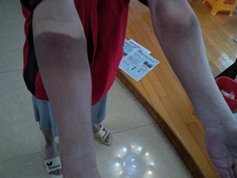 魏先生的手臂被燙傷。網圖