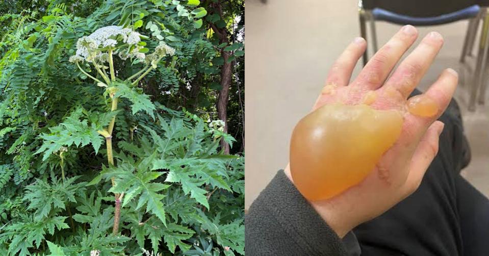 遊日注意 | 北海道大學疑驚現劇毒大豕草 專家發恐怖大水泡照示警