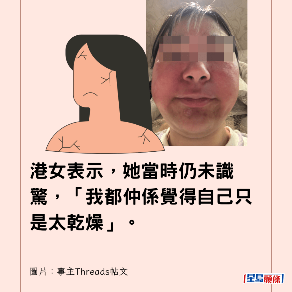 港女表示，她當時仍未識驚，「我都仲係覺得自己只是太乾燥」。