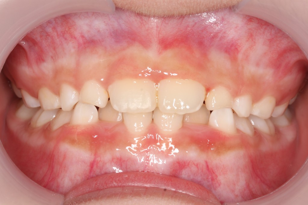 兒童箍牙︳一名有倒及牙的7歲女童，治療前後的對比照。（後）（圖片來源：由受訪者提供）