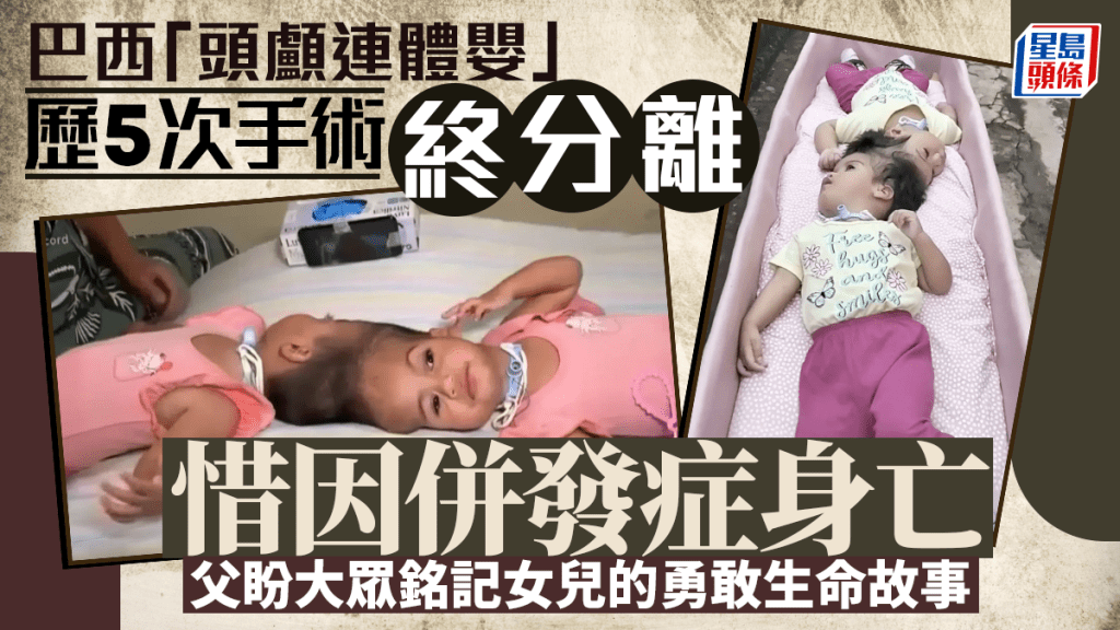 巴西「頭顱連體嬰」分離手術後併發症身亡 父：盼大眾記住女兒勇敢生命故事