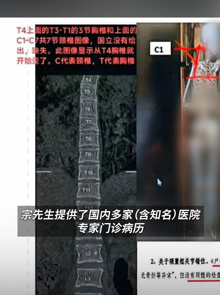 宗先生找国内多间医院分析报告。澎湃新闻