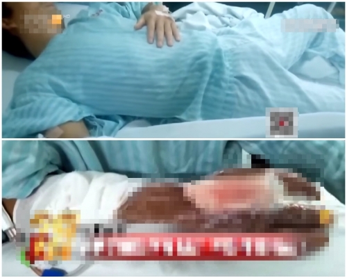 醫生最終為阿志截去了中指。網圖