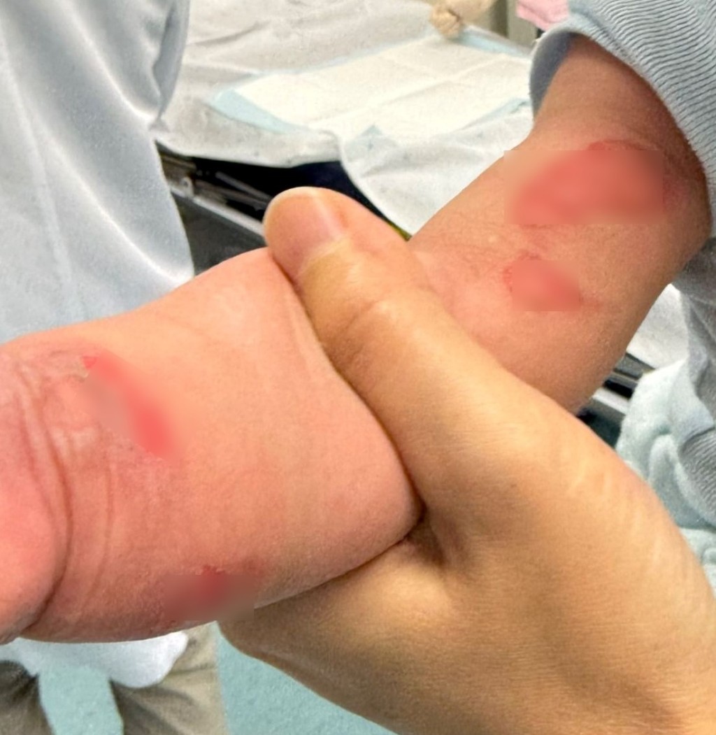 意外燙傷B女隻手又紅又腫 港媽發千字長文呻爆外傭離譜工作態度。fb「聘請工人姐姐關注組」截圖 意外燙傷B女隻手又紅又腫 港媽發千字長文呻爆外傭離譜工作態度。fb「聘請工人姐姐關注組」截圖