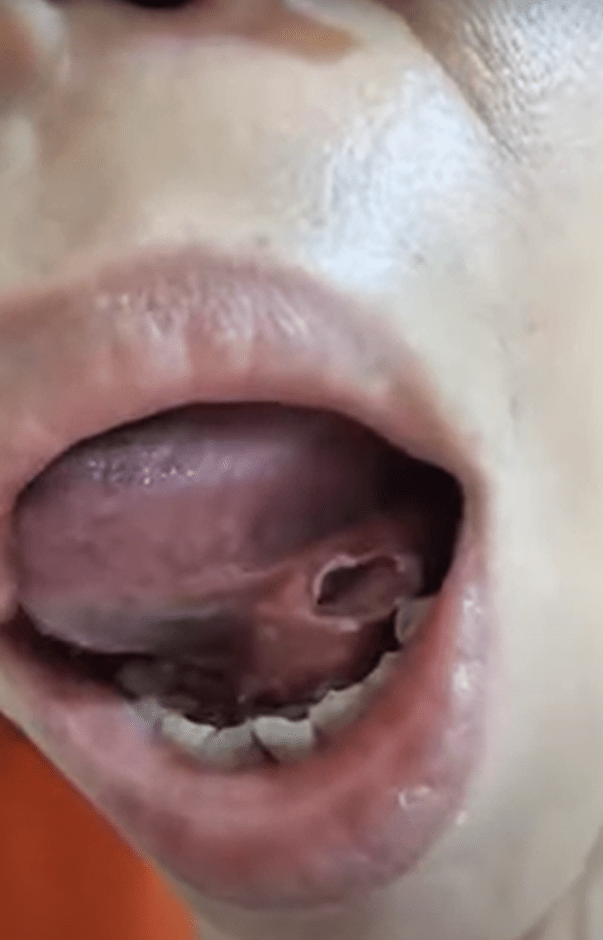 女生在麻醉藥消退後，竟在舌頭下發現有一個大洞。「爆料公社」FB