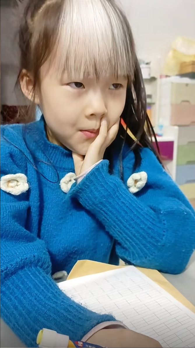 文汐患罕见的“斑驳病”，头上天生显眼的白色浏海。