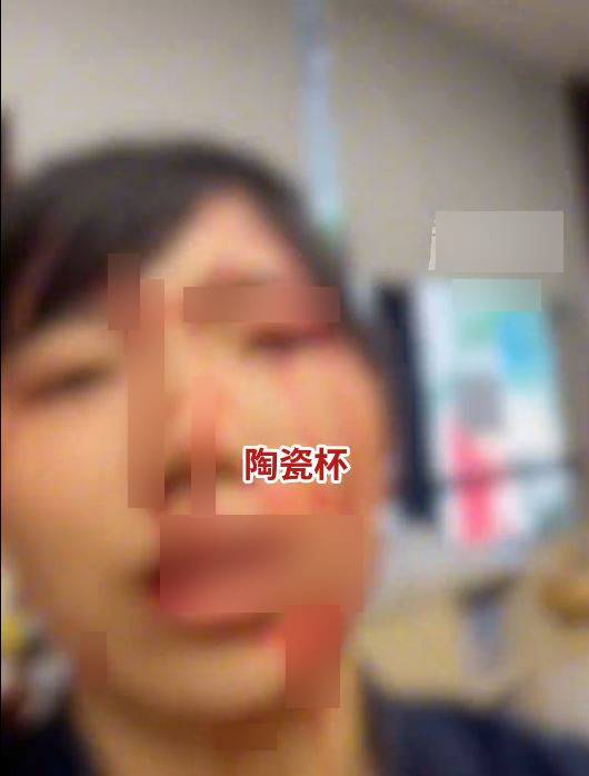 陳小姐被男同事掟杯襲擊,導致臉部重創要縫逾20針毀容。抖音 陳小姐被男同事掟杯襲擊,導致臉部重創要縫逾20針毀容。抖音