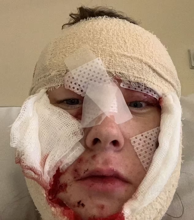 柯薇爾每天必須使用紗布纏住臉，且避免日照。網圖