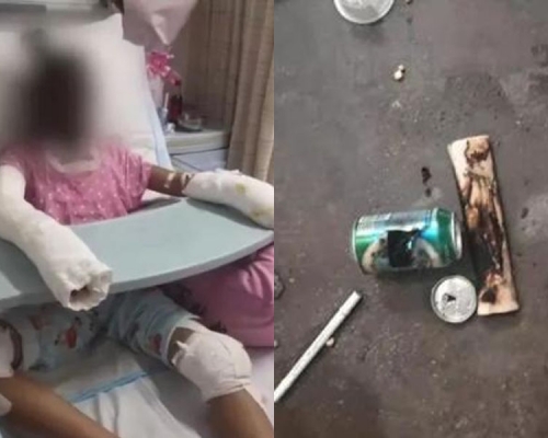 14歲女童模仿汽水罐自製爆谷,嚴重燒傷離世。(網圖)