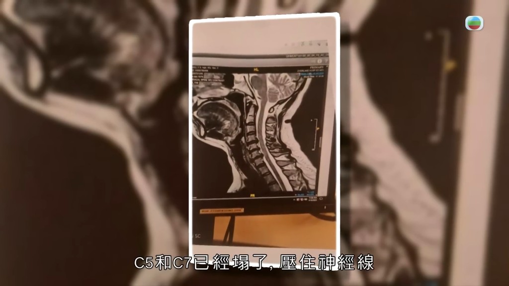陳秀茹頸椎(C4、C5、C7及T1)壓住神經線。 陳秀茹頸椎(C4、C5、C7及T1)壓住神經線。