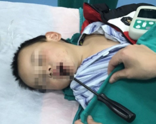 男童送院時口中插著螺絲。網圖