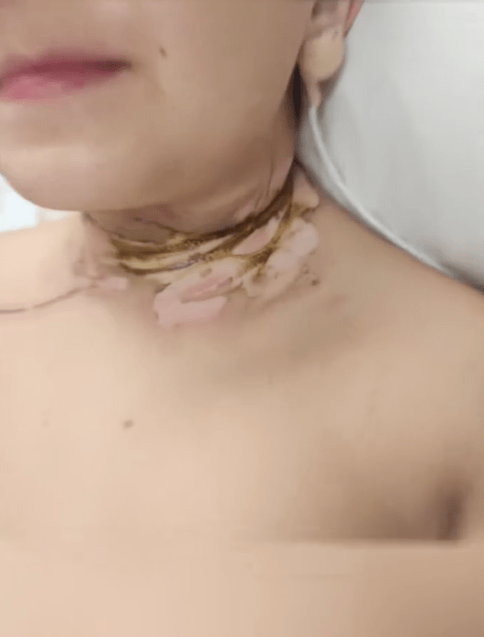 Lorenzo Lopez身上被電流灼傷的疤痕令人悚目驚心。