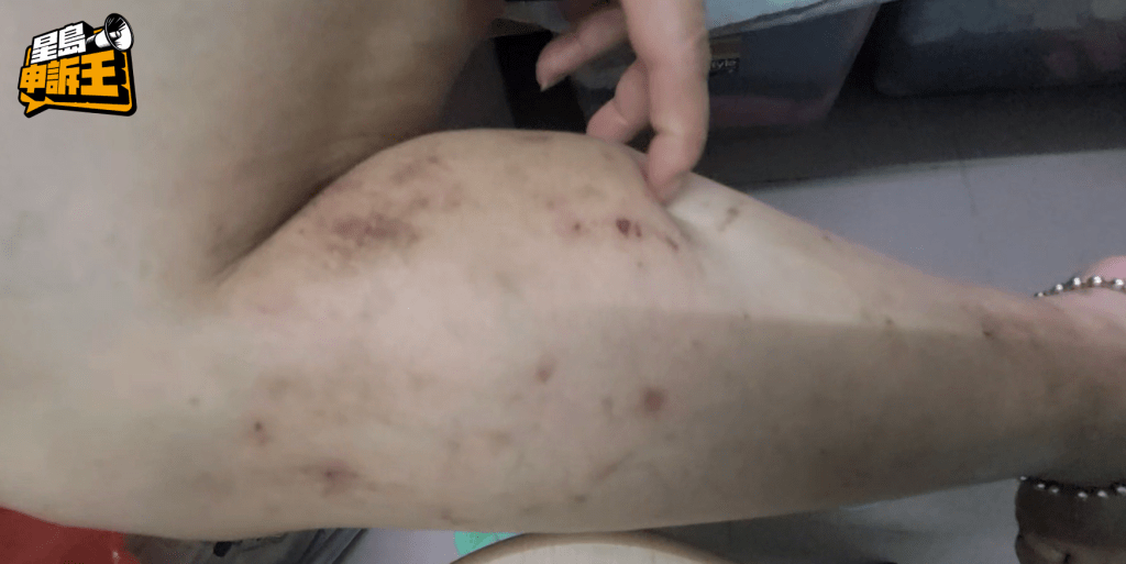 深水埗劏房戶林女士指家中蝨患嚴重，更被咬至滿腳傷痕。