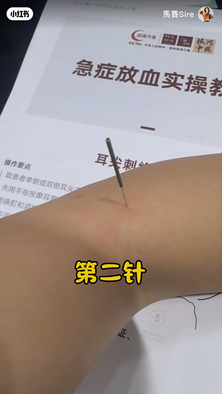 馬賽第二針是拮落臂彎。 馬賽第二針是拮落臂彎。