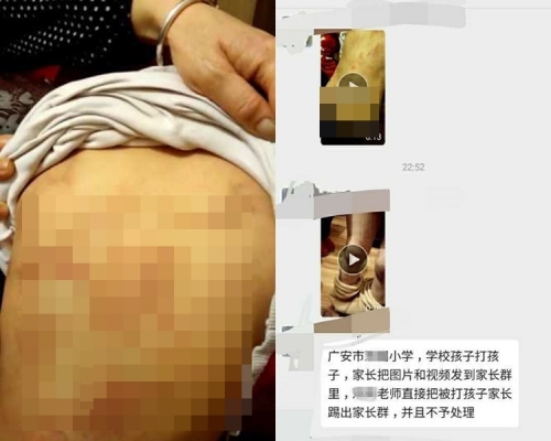 四川一名女童被同學欺凌，身上佈滿傷痕。網圖