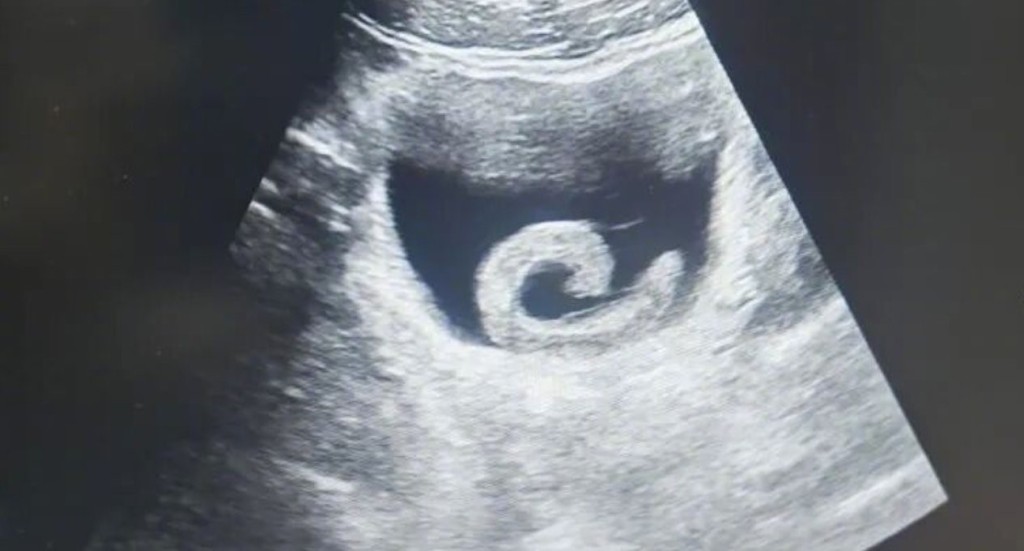 超声波检查下,水蛭被发现在病人膀胱内寄居。《大河报》 超声波检查下,水蛭被发现在病人膀胱内寄居。《大河报》