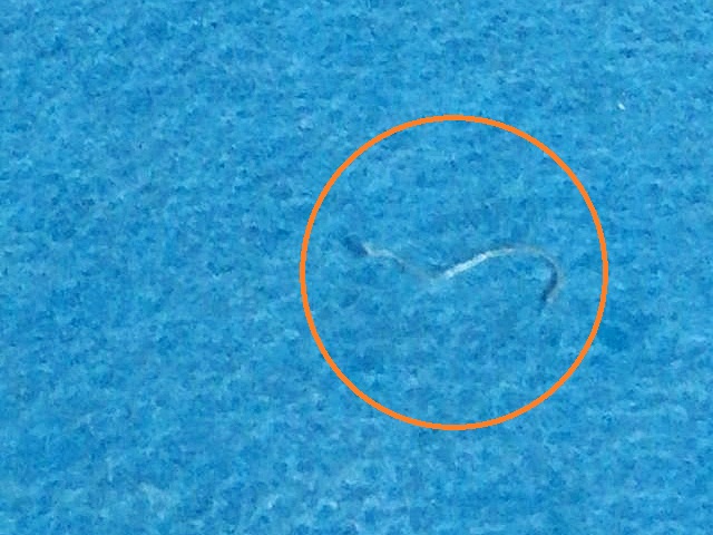 医生取出的结膜吸吮线虫。网图