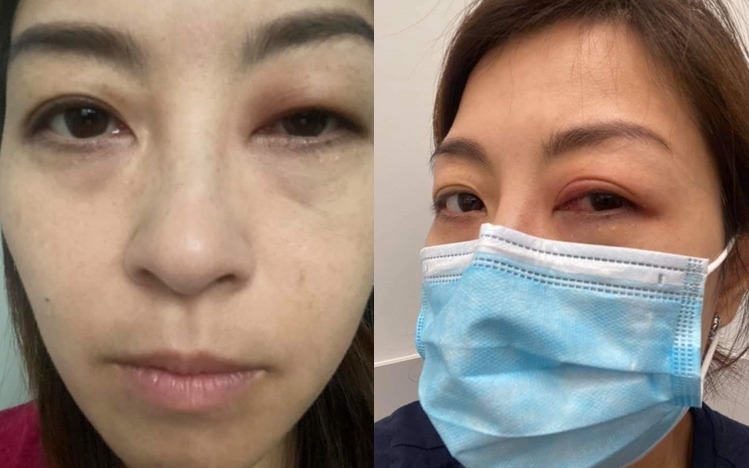 黃璦瑤生眼瘡不斷流濃。