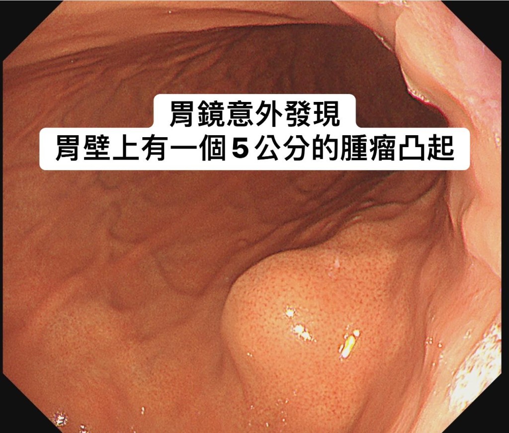 該女子有胰臟癌、乳癌及膽管癌的家族病史，非常警覺地到診所進行健康檢查，照胃鏡時在胃壁發現1顆5cm大小的腫瘤。（圖片來源：林相宏醫生Facebook）