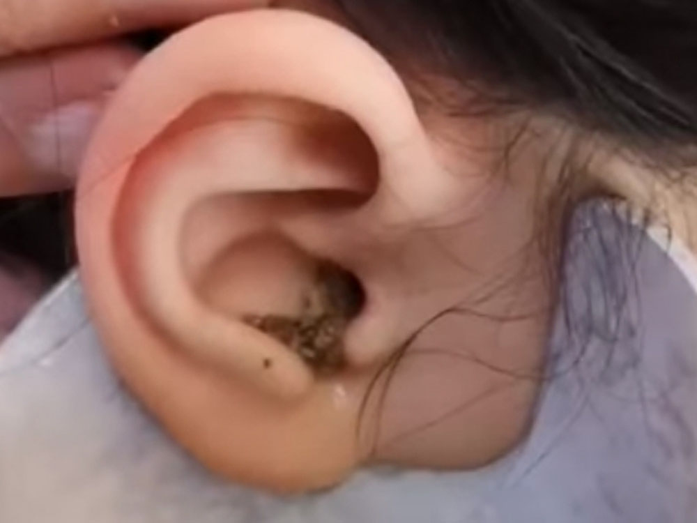 小朋友總是聽不清,不一定是聽覺有問題,可能是耳垢的關係。(網圖)