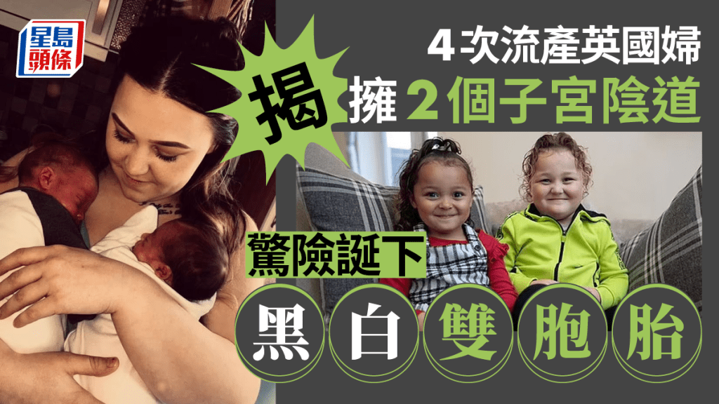 英國一名婦人天生雙子宮雙陰道,流產4次後生下「黑白雙胞胎」。網上圖片
