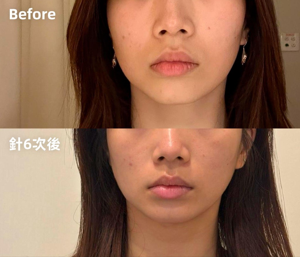 陳小姐因為長期側睡、單邊咀嚼，導致面部輪廓不對稱。