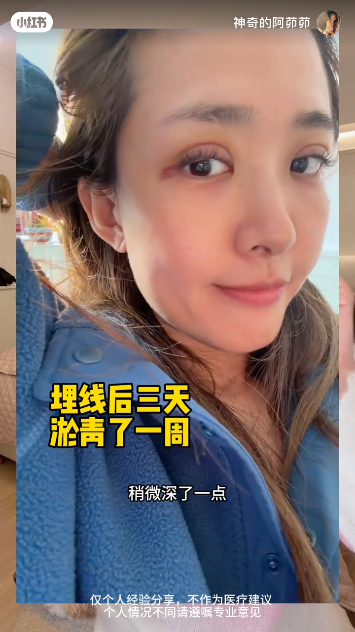 張茆展示第二次「埋線」手術後，初期的恢復狀況，可見眼部有明顯的紅腫和瘀青。