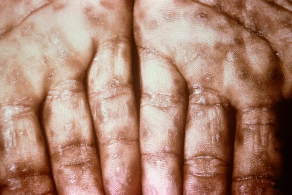 第二期梅毒的典型表現：手掌上出現皮疹。 Wiki