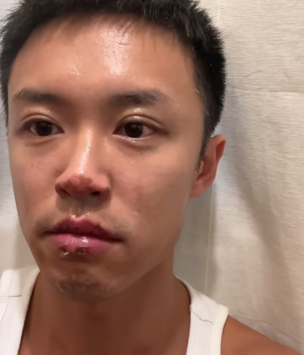 顧定軒早前突然清空社交網，同時展示面部、身上傷痕纍纍的照片。