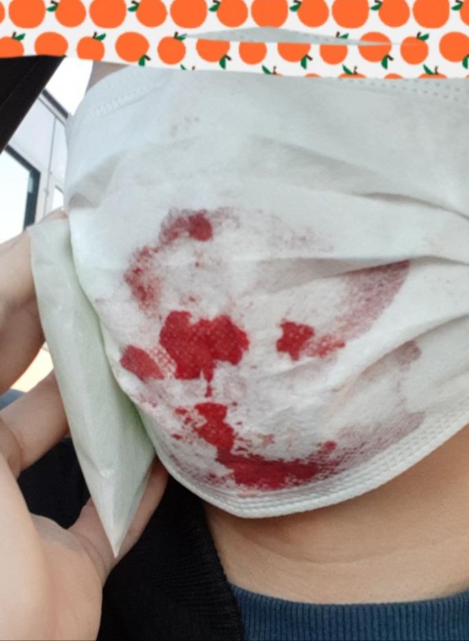 男子口罩渗出血。网图