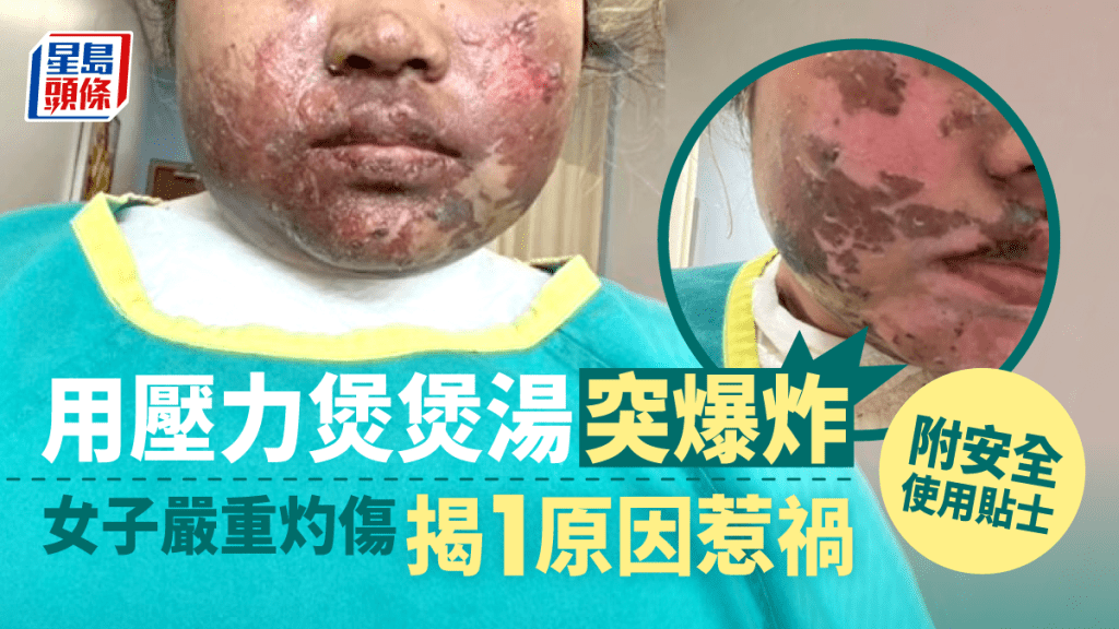 一名26岁女子使用压力煲煲汤时，突然爆炸，遭滚汤灼伤脸部及身体。