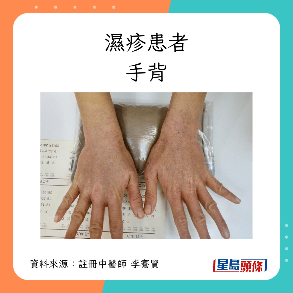 濕疹患者手背康復過程