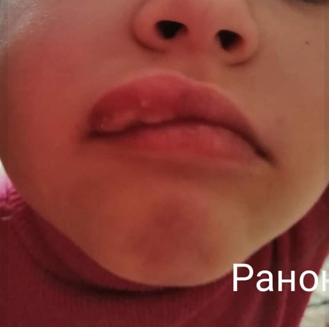 烏克蘭6歲女童睇牙醫後嘴巴異常腫脹。（網圖）