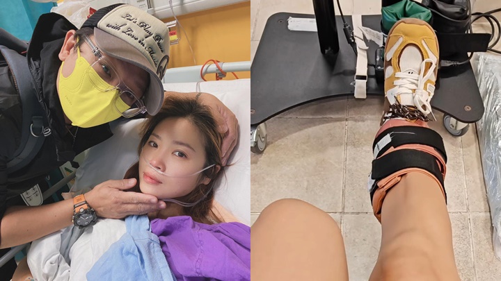 前亞姐鄭伊娜跌斷腳近一年回歸幕前無期 腳踝腫起劇痛不能提重物要撐枴杖助行