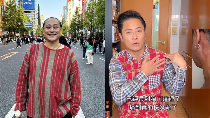 楊天命去年「生蛇」仍隱隱作痛,多位圈中藝人亦曾中招。