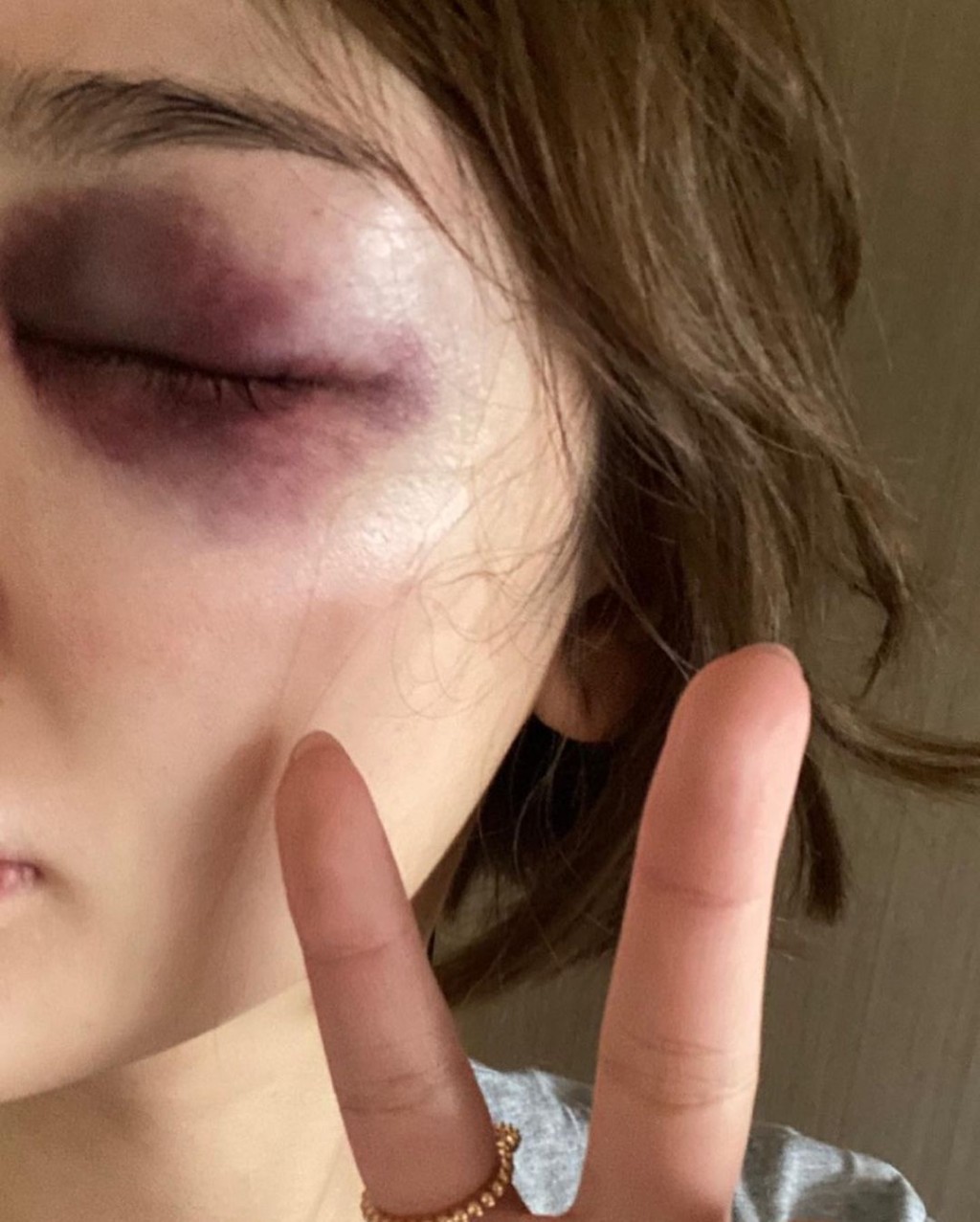 Kiwi於IG晒又腫又瘀傷眼照。