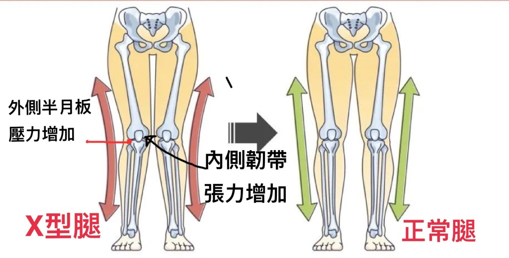 如果膝蓋中心坐落在內側腳踝甚至腳踝的內側，便可能有X形腿；而趾公姆外翻等，通常都會與X形膝同時出現。圖片由筆者提供