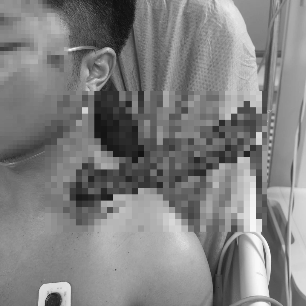 一根直徑從樹上掉落的枯枝從男子頸部貫入直達胸腔。 一根直徑從樹上掉落的枯枝從男子頸部貫入直達胸腔。