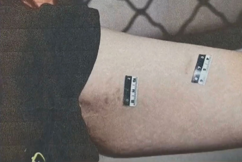 受害人激烈掙扎下雙臂留下大量瘀痕。