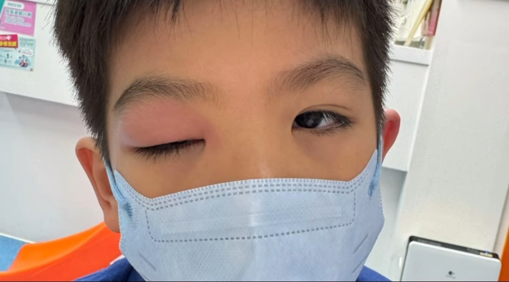 黎諾懿昨日（18日）在IG貼出小春雞慘被可惡的蚊叮咬，令到右眼又紅又腫。