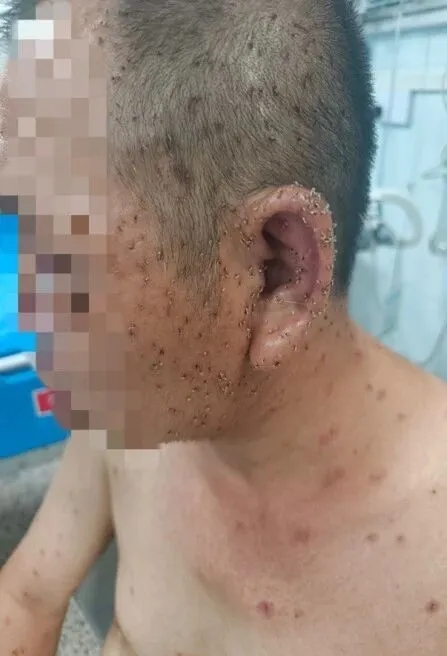 男事主头面部、双唇及手背等裸露部位布满带有倒钩和毒囊的黑色毒刺，粗略估计多达近千根。