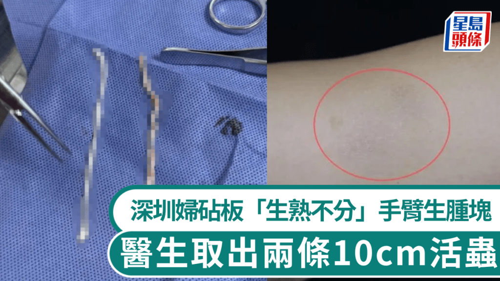 深圳妇砧板「生熟不分」手臂生肿块，医生取出两条10cm活虫。 