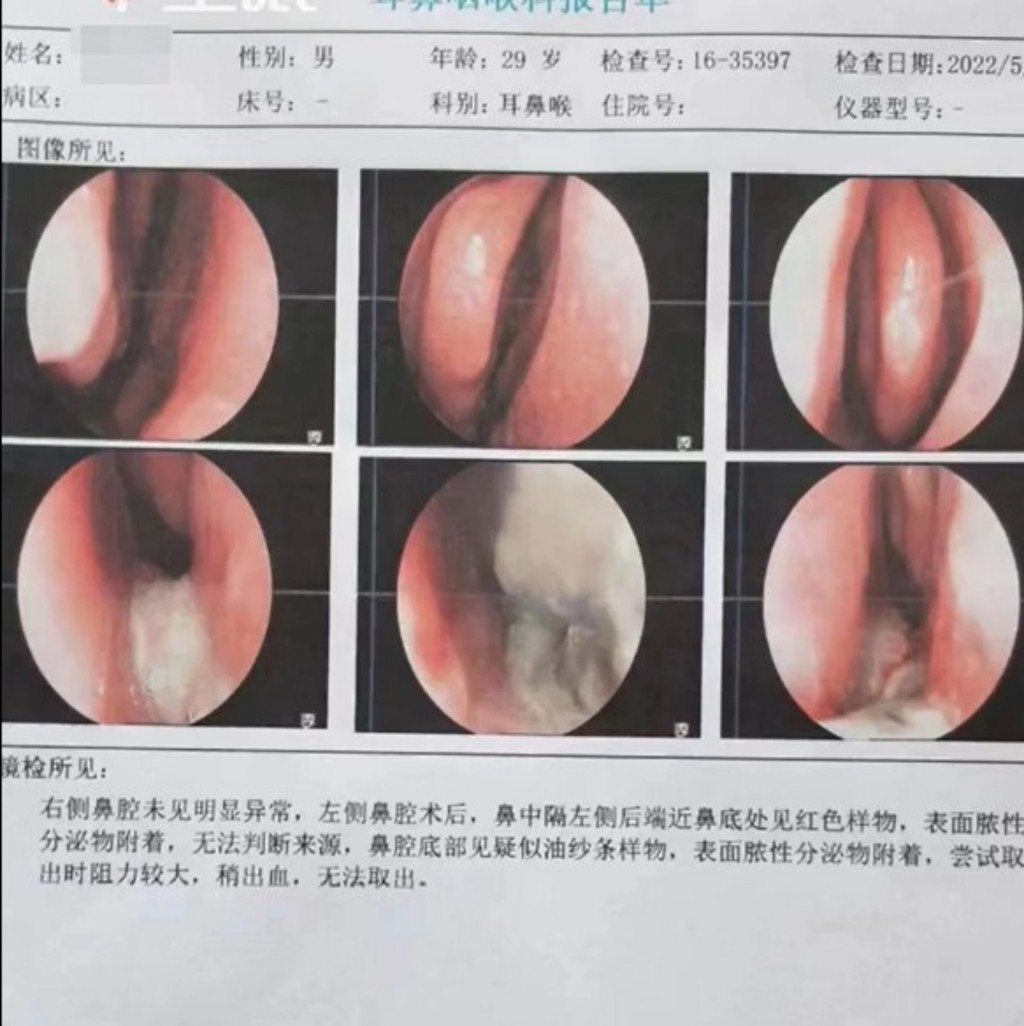 醫院做了檢查照出鼻內有長修形物體。網圖