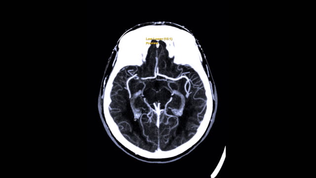 该5个案例患者，幼年时因体内缺乏生长激素，分别于1959至1985年间从死者身上接收脑下垂体生长激素，其后出现阿兹海默症症状，当中3人的大脑扫描结果与诊断一致。