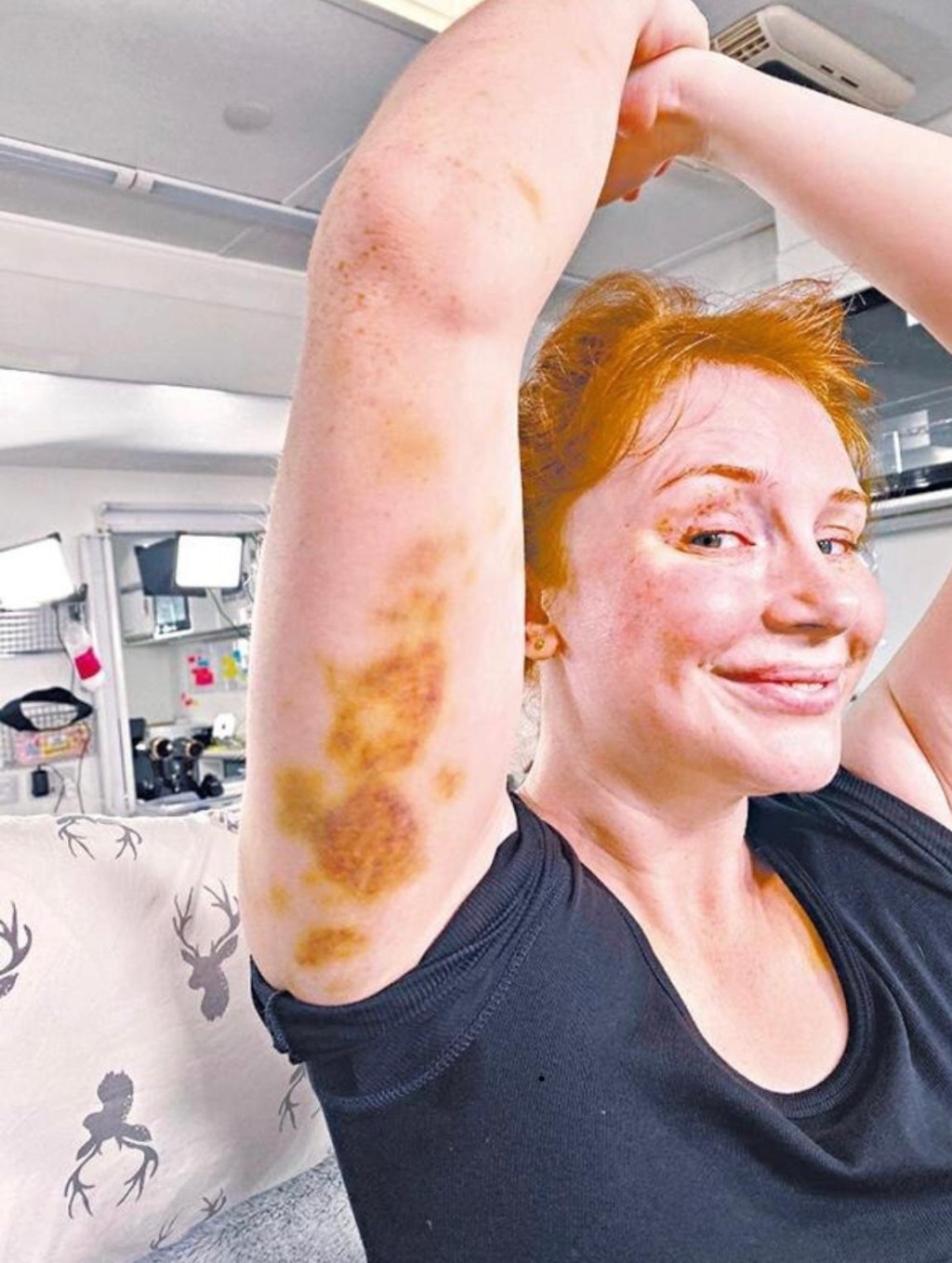 《侏羅紀世界：統治霸權》女主角Bryce Dallas Howard早前在拍攝過程受傷。