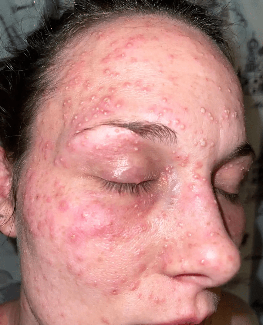 美國女子Taylor Rogers臉部被紅火蟻嚴重咬傷。