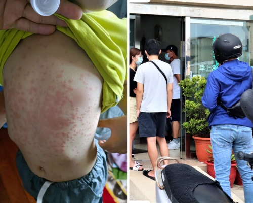 患者皮膚會出現紅疹及痕癢。(活力澎湖公益平台FB圖片)