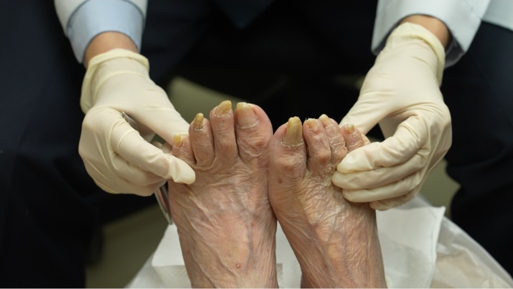 92岁潘婆婆的脚甲十年来没有修剪，角质不断向下增生，并且引起发炎及灰甲问题。