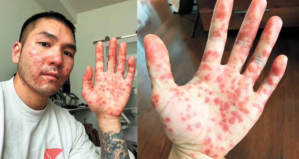 美國一名華裔男子患上猴痘卻多次被誤診。（網上圖片）