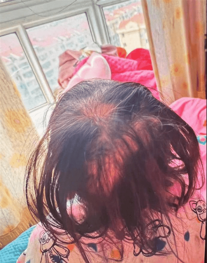 鉈中毒女童已痊癒出院,警方指是人為投毒。 鉈中毒女童已痊癒出院,警方指是人為投毒。